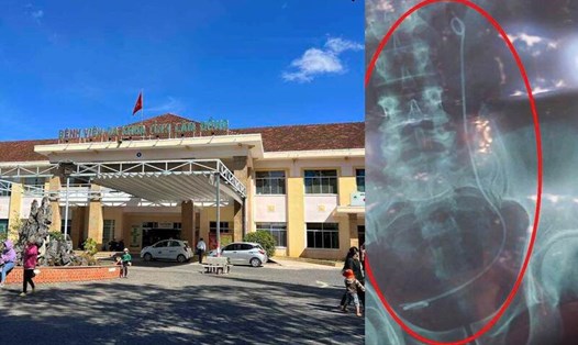 Bệnh nhân phải mổ vì bị trả nhầm kết quả X-quang tại Bệnh viện đa khoa tỉnh Lâm Đồng. Ảnh đồ hoạ: Hương Giang