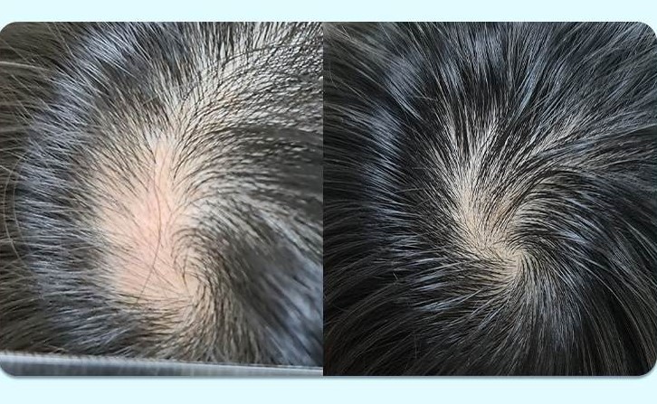 Tình trạng rụng tóc của trẻ được cải thiện sau điều trị. Ảnh: Bệnh viện Tâm Anh TPHCM