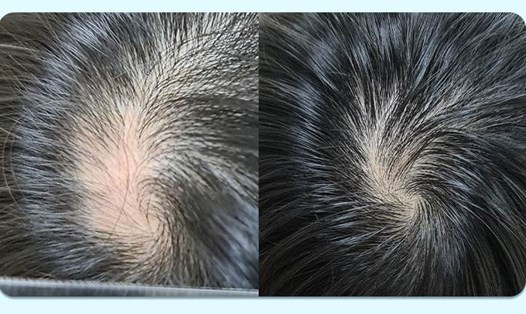 Tình trạng rụng tóc của trẻ được cải thiện sau điều trị. Ảnh: Bệnh viện Tâm Anh TPHCM
