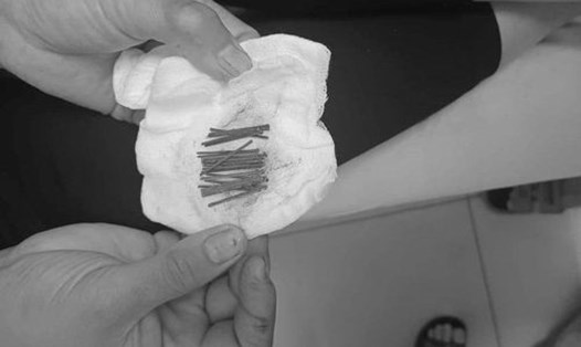 23 chiếc đinh ghim được lấy ra từ bụng bé trai 2 tuổi ở Nghệ An.  Ảnh: Hải Đăng 