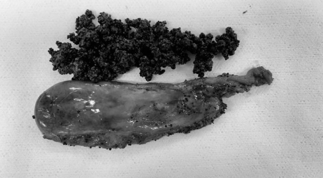 Sỏi mật của người phụ nữ được bác sĩ lấy ra. Ảnh: HƯƠNG SƠN 