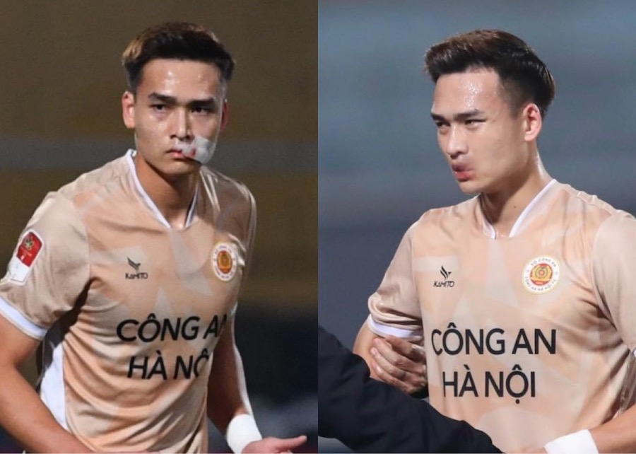 Trung vệ Bùi Hoàng Việt Anh khâu 24 mũi ở miệng sau vòng 13 V.League. Ảnh: Minh Xuân