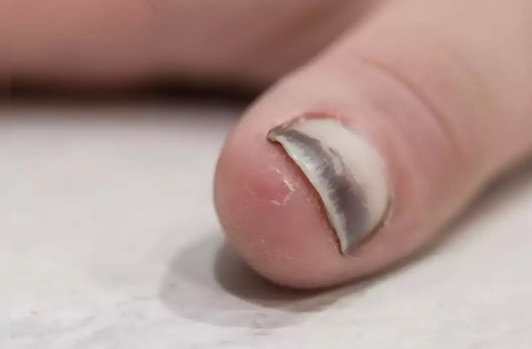 Móng tay bầm tím tiềm ẩn nhiều nguy cơ về sức khoẻ. Ảnh: Pixabay