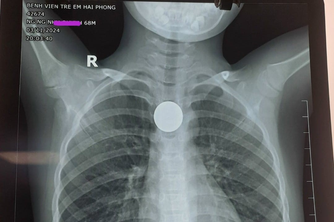 Hình ảnh dị vật cản âm tròn đều, mật độ như kim loại nằm ở thực quản ngực của bệnh nhân. Ảnh: Bệnh viện cung cấp