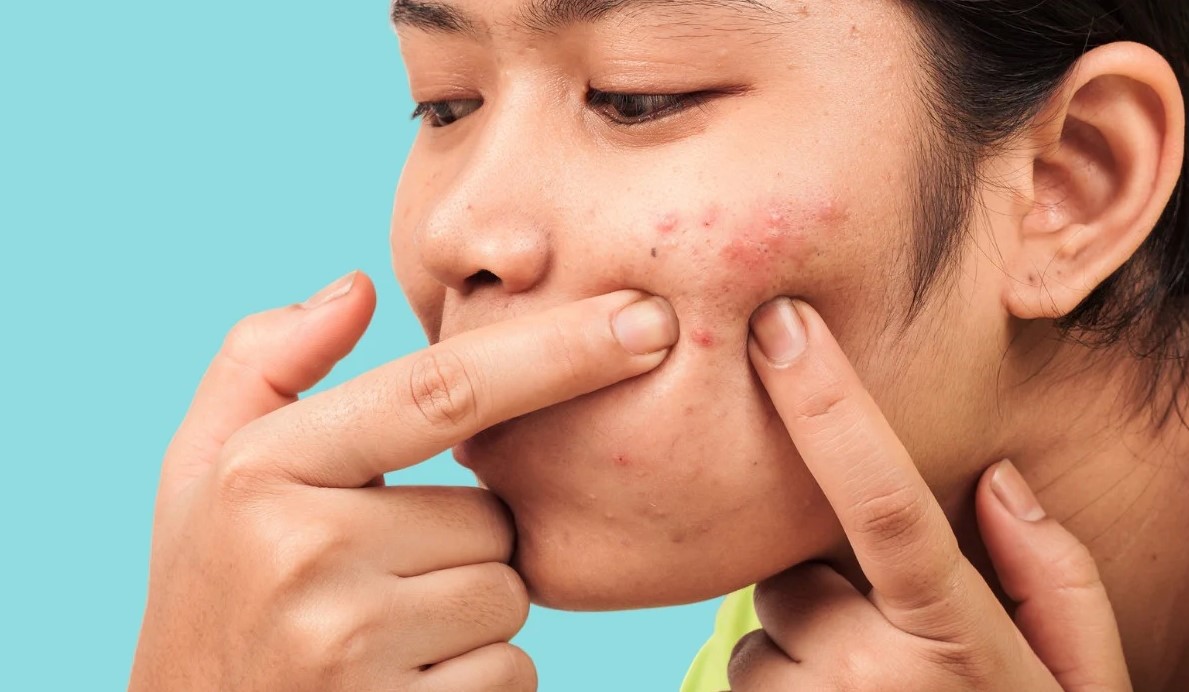 Nặn mụn sai cách dễ gây một số tác hại trên da mặt. Ảnh: Pixabay