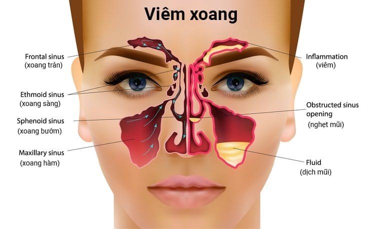 Viem xoang la can benh man tinh anh huong truc tiep suc khoe nguoi benh.