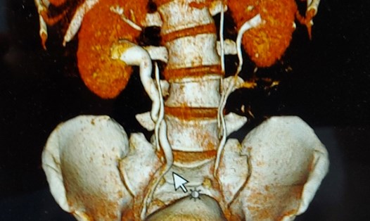Hình ảnh chụp X-quang phát hiện người đàn ông ở Hà Nội có 4 quả thận. Ảnh: BVCC
