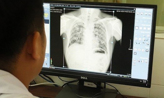 Ảnh chụp phổi của một công nhân Công ty TNHH Châu Tiến. Ảnh: Quang Đại