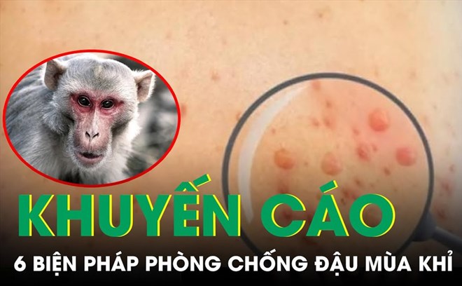 Kiên Giang ghi nhận 3 ca mắc đậu mùa khỉ. Ảnh minh họa