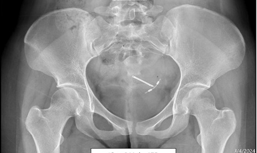 Hình ảnh chụp X-Quang của bệnh nhân có vòng tránh thai đi lạc. Ảnh: ĐÌNH CHÍNH