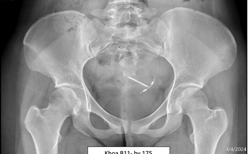 Hình ảnh chụp X-Quang của bệnh nhân có vòng tránh thai đi lạc. Ảnh: ĐÌNH CHÍNH