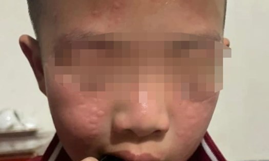 Một học sinh Trường Tiểu học Hải Bối (huyện Đông Anh, Hà Nội) có biểu hiện bị dị ứng sau khi trường phun thuốc diệt muỗi. Ảnh: NVCC