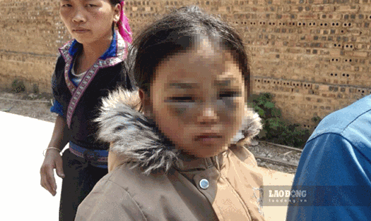 Hình ảnh bé gái lớp 1 trường Phổ thông dân tộc bán trú TH&THCS La Pán Tẩn nghi bị cô giáo đánh tím mắt. Ảnh: Gia đình cung cấp