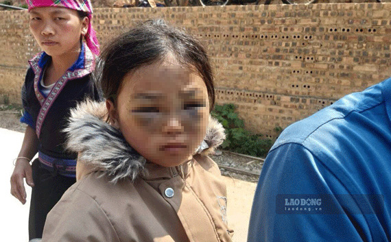 Hình ảnh bé gái lớp 1 nghi bị cô giáo đánh tím mắt. Ảnh: Gia đình cung cấp 
