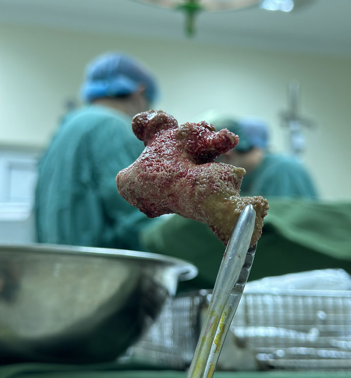 Khối sỏi san hô sau khi được lấy ra. Ảnh: BVCC