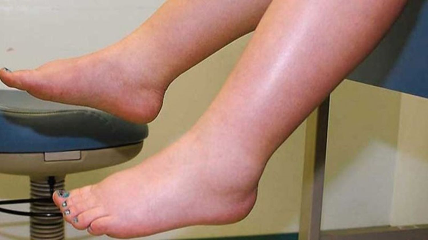 Có nhiều cách làm giảm phù nề cho mẹ bầu. Ảnh: Bích Nhung