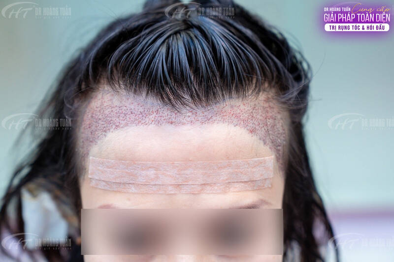 Hạ đường chân tóc ‘’định hình khuôn mặt’’. Ảnh: Dr Hoàng Tuấn   