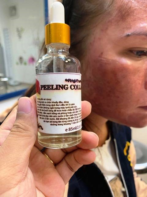  Nạn nhân của mỹ phẩm rởm phải đến viện điều trị. Ảnh: Hương Giang