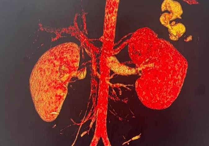 Hình ảnh thận bệnh nhân bị tổn thương. Ảnh: Bệnh viện cung cấp