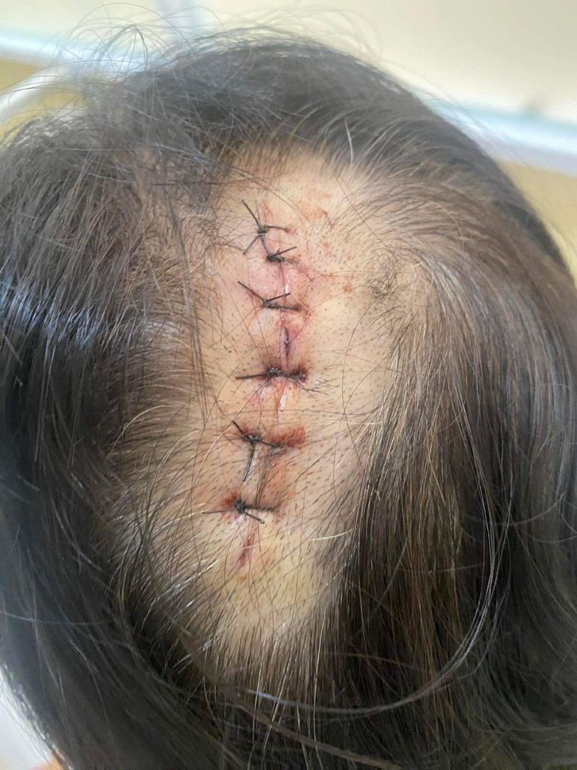 Một nạn nhân bị đối tượng đánh vùng đầu phải nhập viện. Ảnh: H.Tuấn