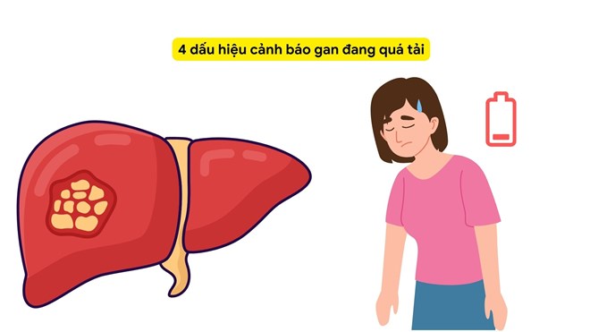 4 dấu hiệu cảnh báo gan đang quá tải