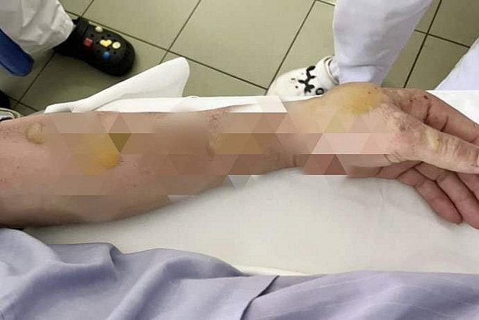 Cánh tay bệnh nhân bị bỏng nặng. Ảnh: BVCC