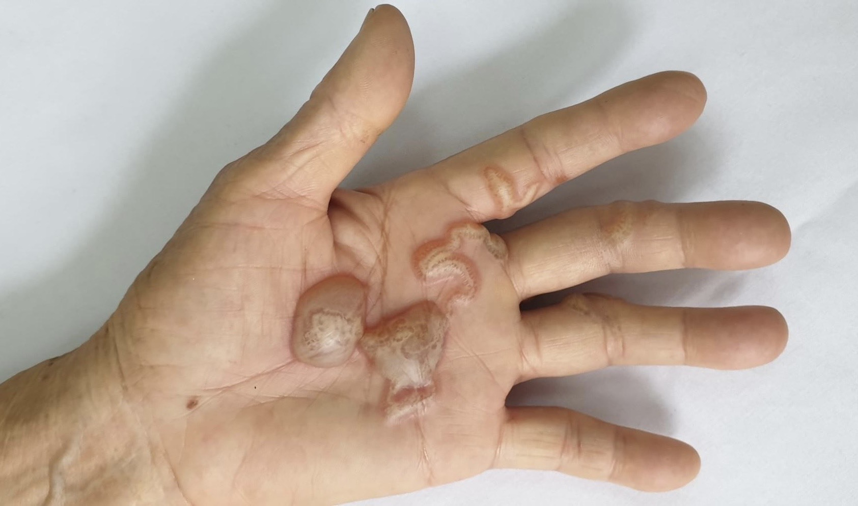 Ấu trùng giun móc chó, mèo tạo đường hầm và gây tổn thương trên da người. Ảnh: BVCC