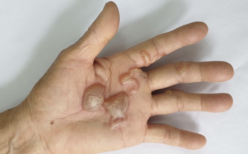 Ấu trùng giun móc chó, mèo tạo đường hầm và gây tổn thương trên da người. Ảnh: BVCC
