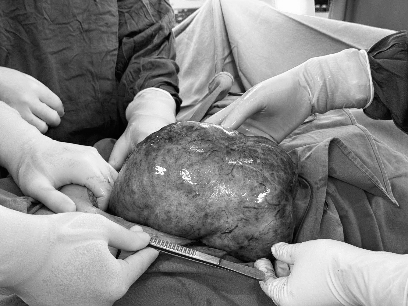 Khối u buồng trứng nặng gần 3kg được cắt bỏ thành công. Ảnh: BVCC