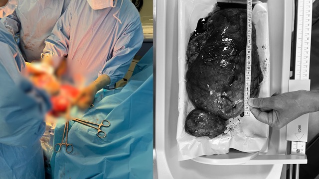 Bác sĩ bóc tách thành công khối u cho sản phụ. Ảnh: BVCC