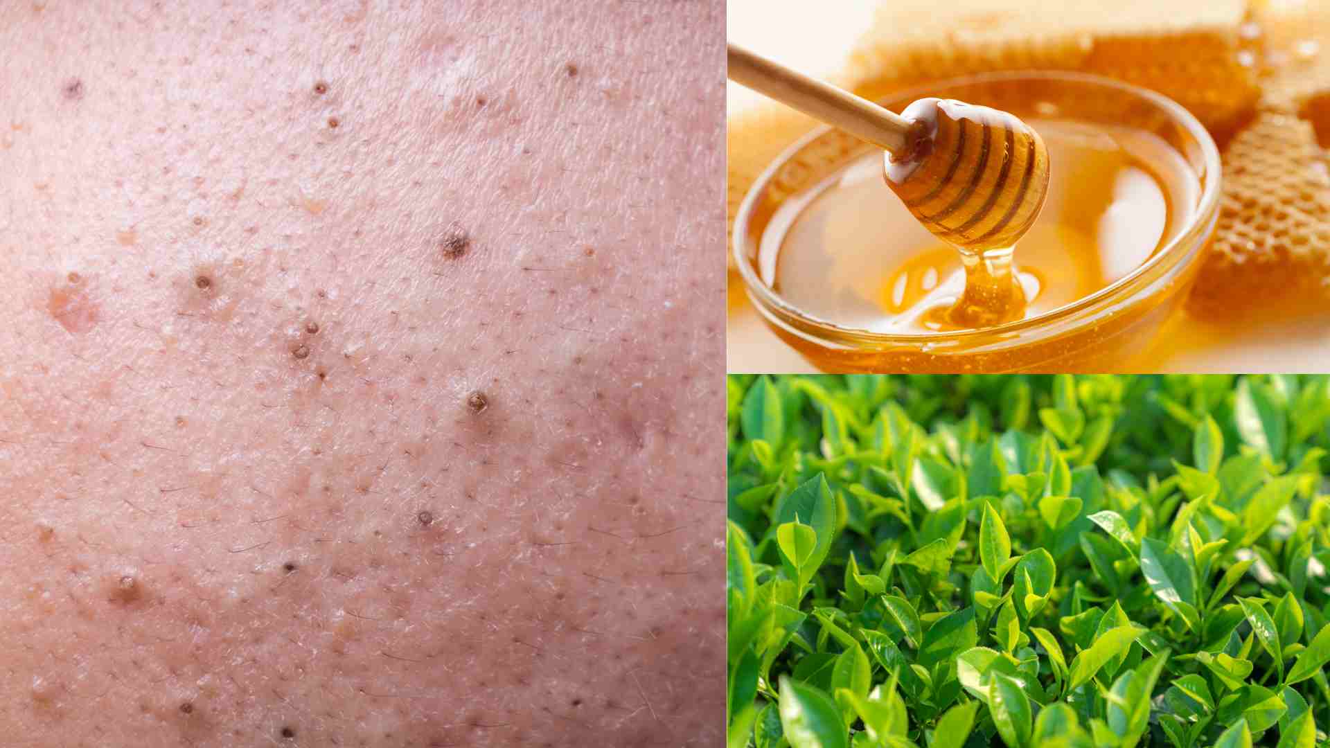 Giảm mụn đầu đen tại nhà bằng nguyên liệu tự nhiên. Đồ họa: Minh Anh