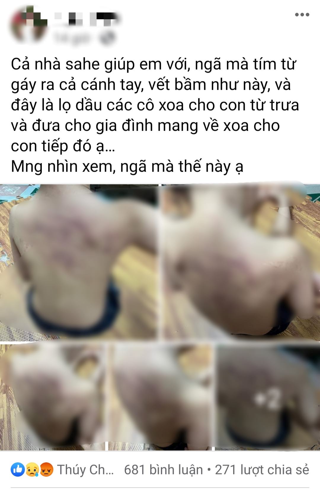 Hình ảnh lan truyền trên mạng xã hội ngày 16.5 về việc cháu bé 5 tuổi bị vết bầm lớn khi đến trường. 