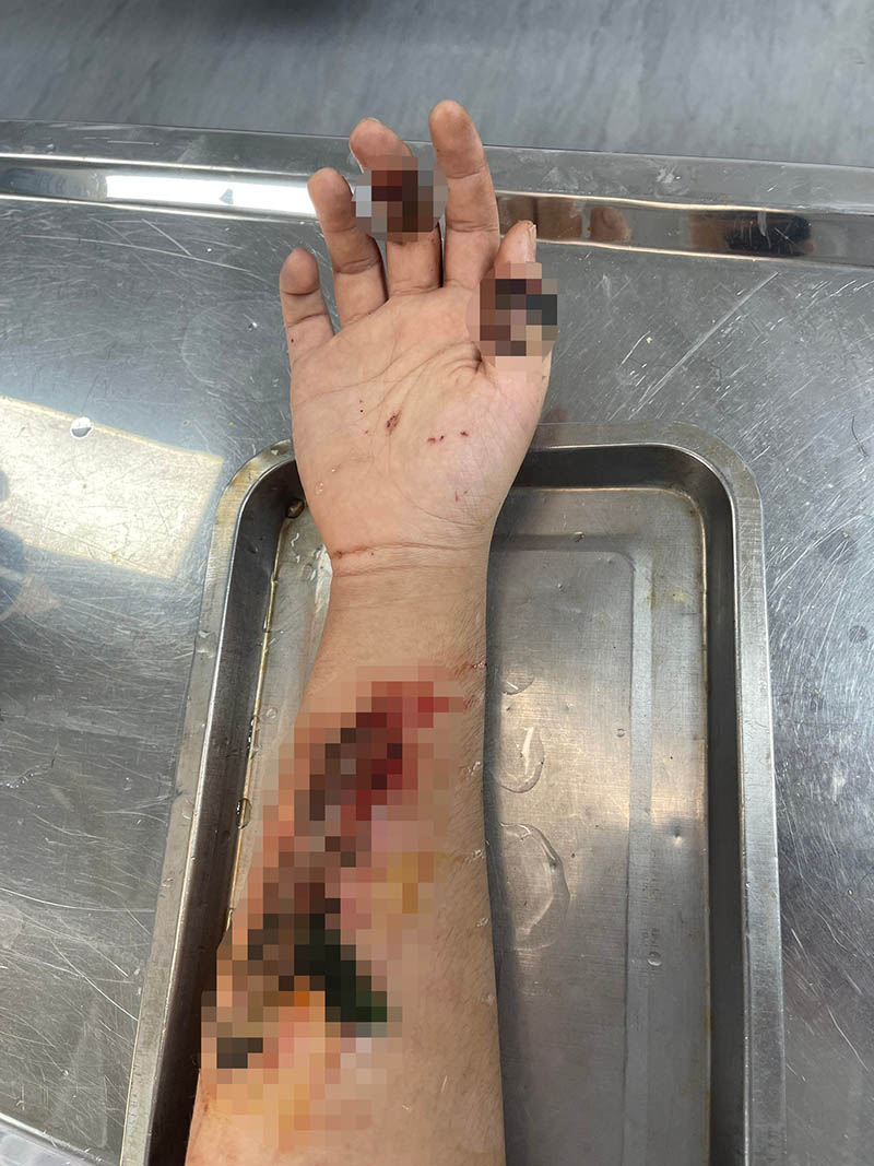 Cánh tay bị hoại tử do đắp lá. Ảnh: BVCC