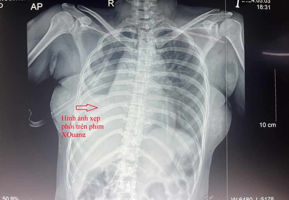 Hình ảnh xẹp phổi ,tràn khí màng phổi trên phim X-quang ngực. Ảnh: BVCC. 