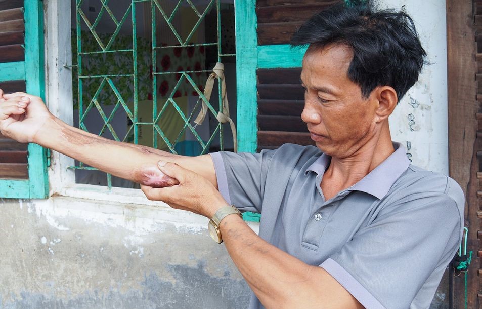 Anh Mai Thanh Phong sau vụ tại nạn lao động sức khoẻ vẫn chưa hồi phục. Ảnh: Nhật Hồ