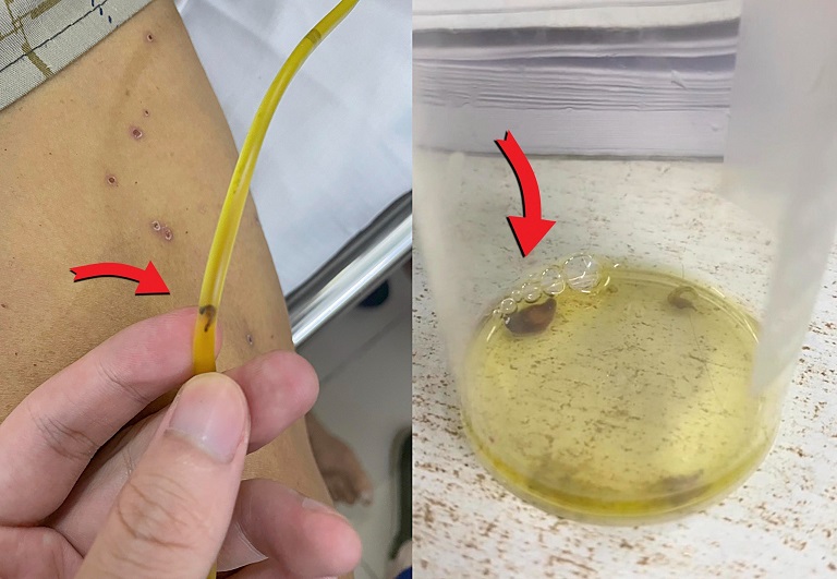 Hình ảnh sán lá gan chui ra từ ống dẫn lưu đường mật. Ảnh: Bệnh viện cung cấp