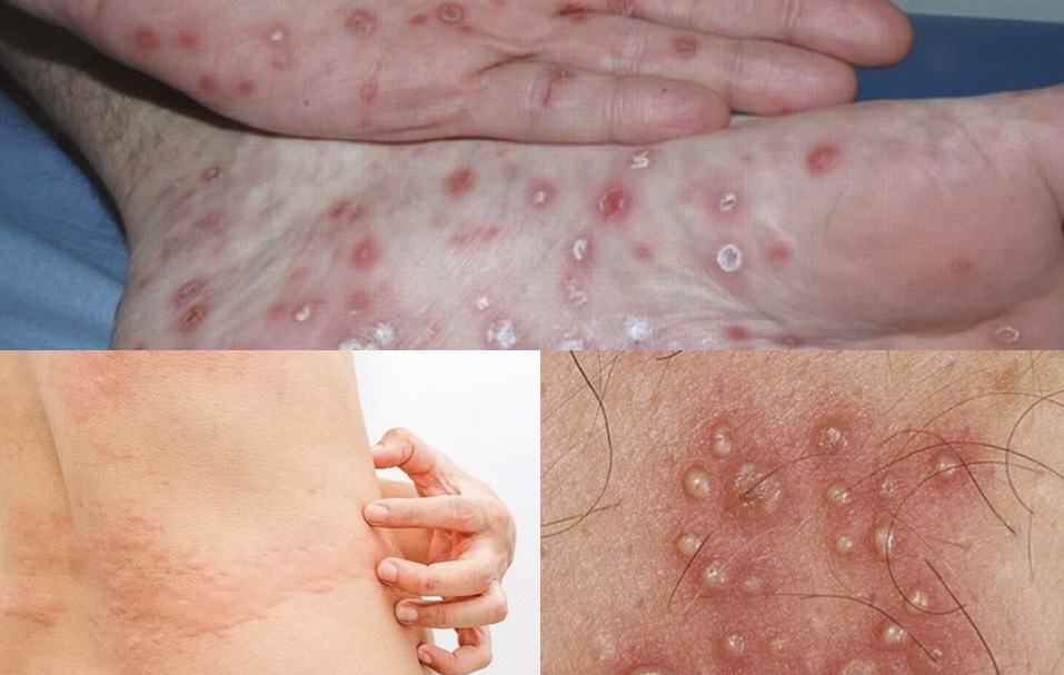 Phòng bệnh giang mai, bảo vệ sức khỏe của bạn. Đồ họa: Hương Giang