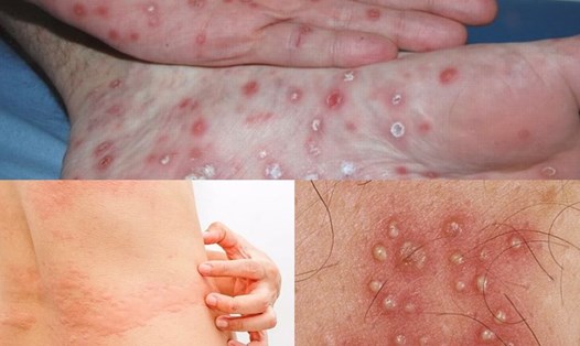 Phòng bệnh giang mai, bảo vệ sức khỏe của bạn. Đồ họa: Hương Giang