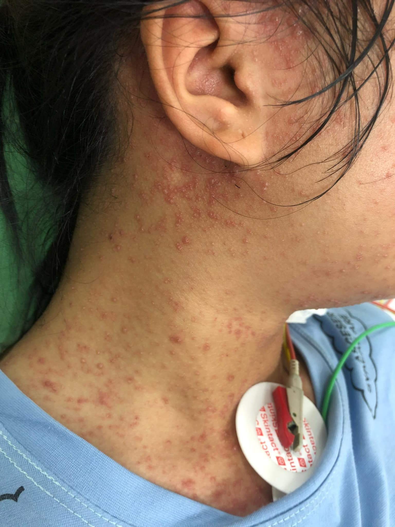 Bệnh nhân biến chứng thuỷ đậu. Ảnh: BVCC