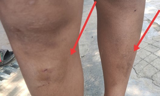 Thương tích ở chân của một đứa trẻ sau khi bị hai mẹ con bà T đánh. Ảnh: Uy Nguyễn