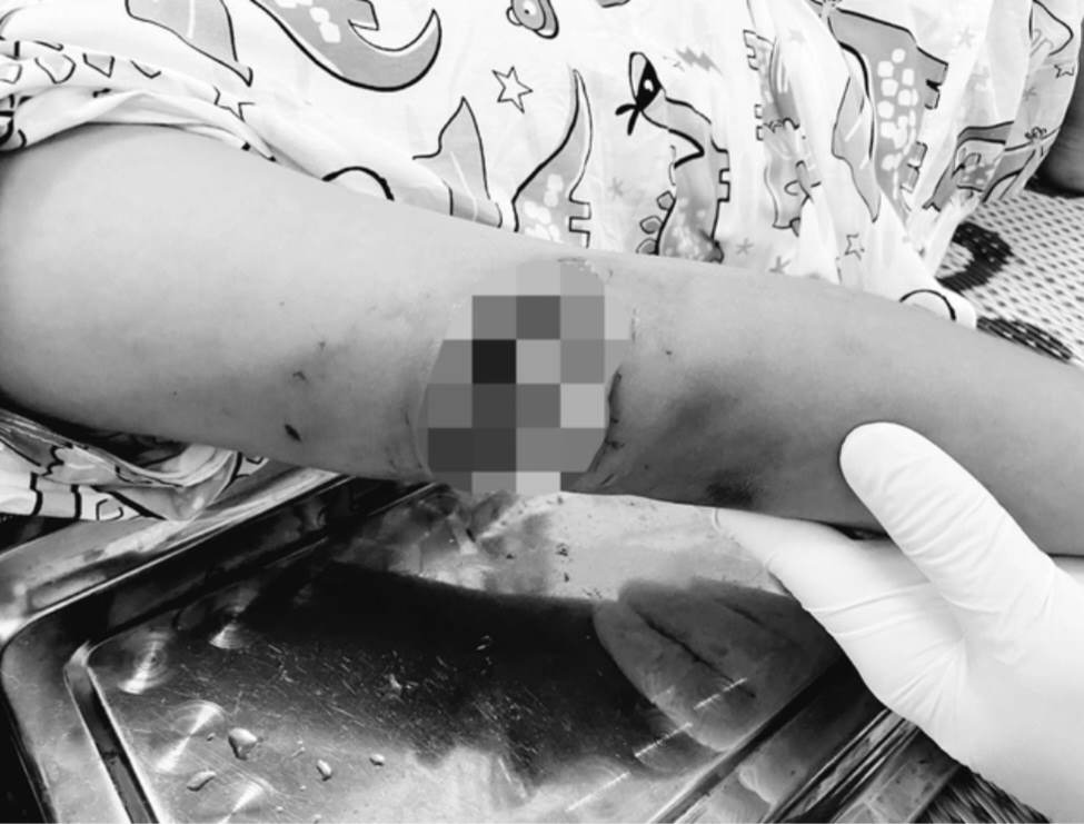 Vết thương của cháu bé sau khi bị chó dại cắn. Ảnh: CDC Thừa Thiên Huế.
