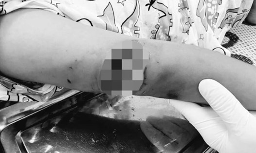 Vết thương của cháu bé sau khi bị chó dại cắn. Ảnh: CDC Thừa Thiên Huế.