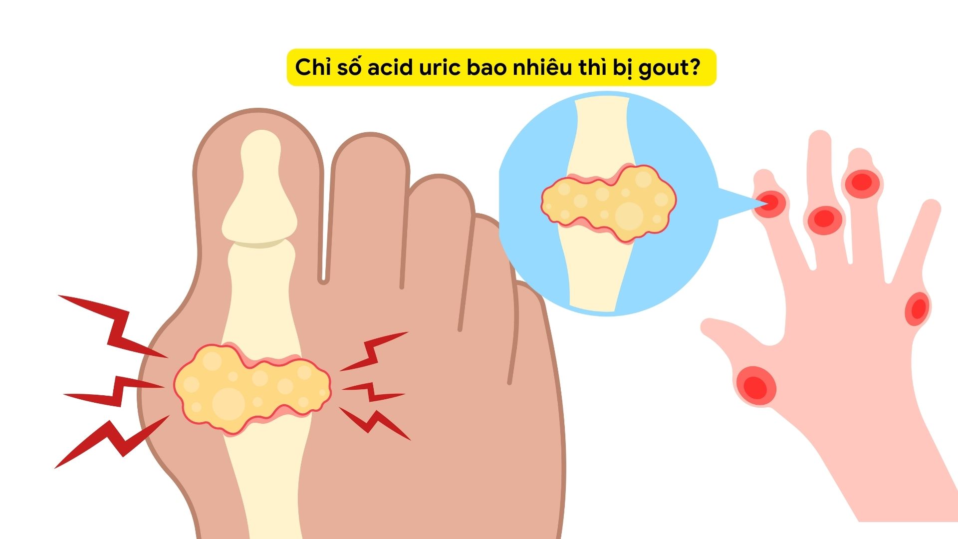 Chỉ số axit uric bao nhiêu thì bị gout?
