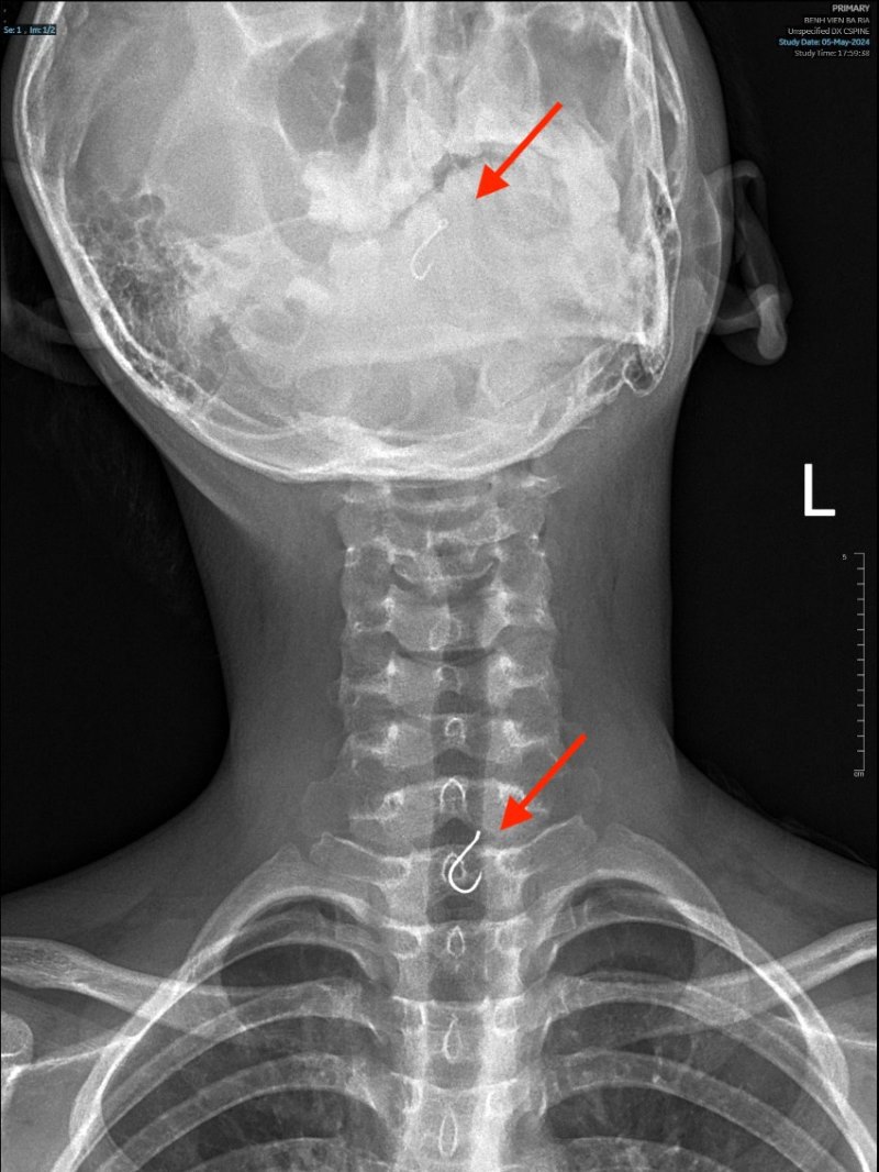 Hình chụp x-quang của bệnh nhân. Ảnh: BVCC