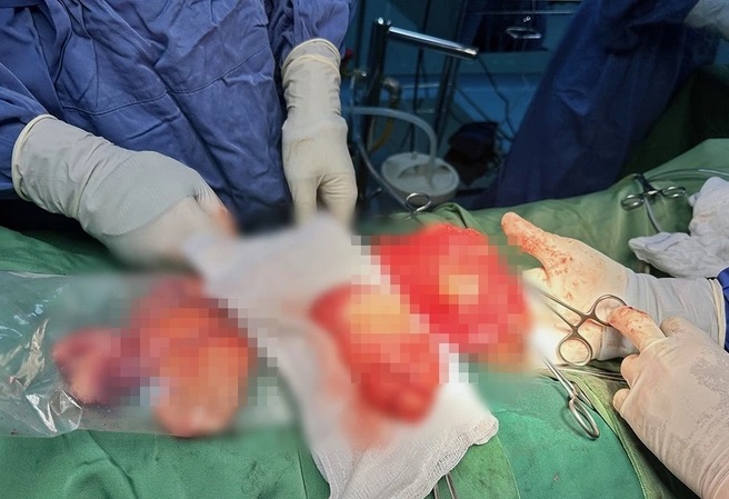 Khối tinh hoàn nặng gần 1kg được bác sĩ phẫu thuật thành công. Ảnh: BVCC