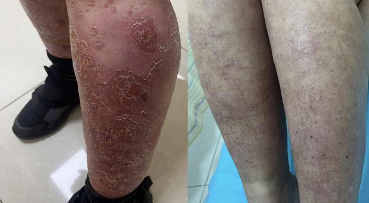 Chân bệnh nhân trước bị chảy mủ và sau thời gian điều trị. Ảnh: BSCC