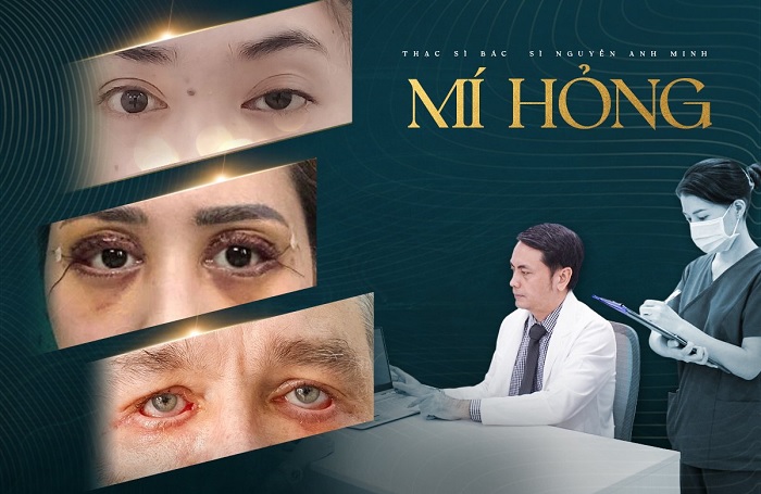 Hình ảnh mí mắt hỏng. Ảnh: Bs. Nguyễn Anh Minh