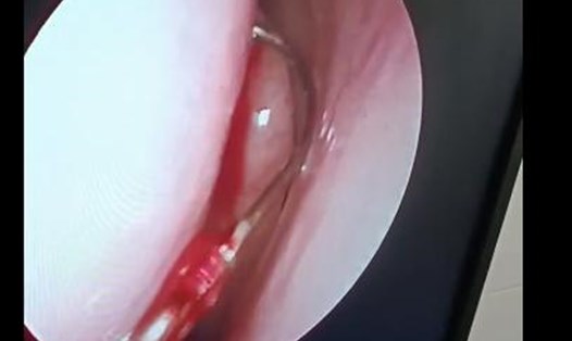 Hình ảnh nội soi chiếc lưỡi câu mắc trong mũi bệnh nhân. Ảnh: TTYT Giồng Riềng