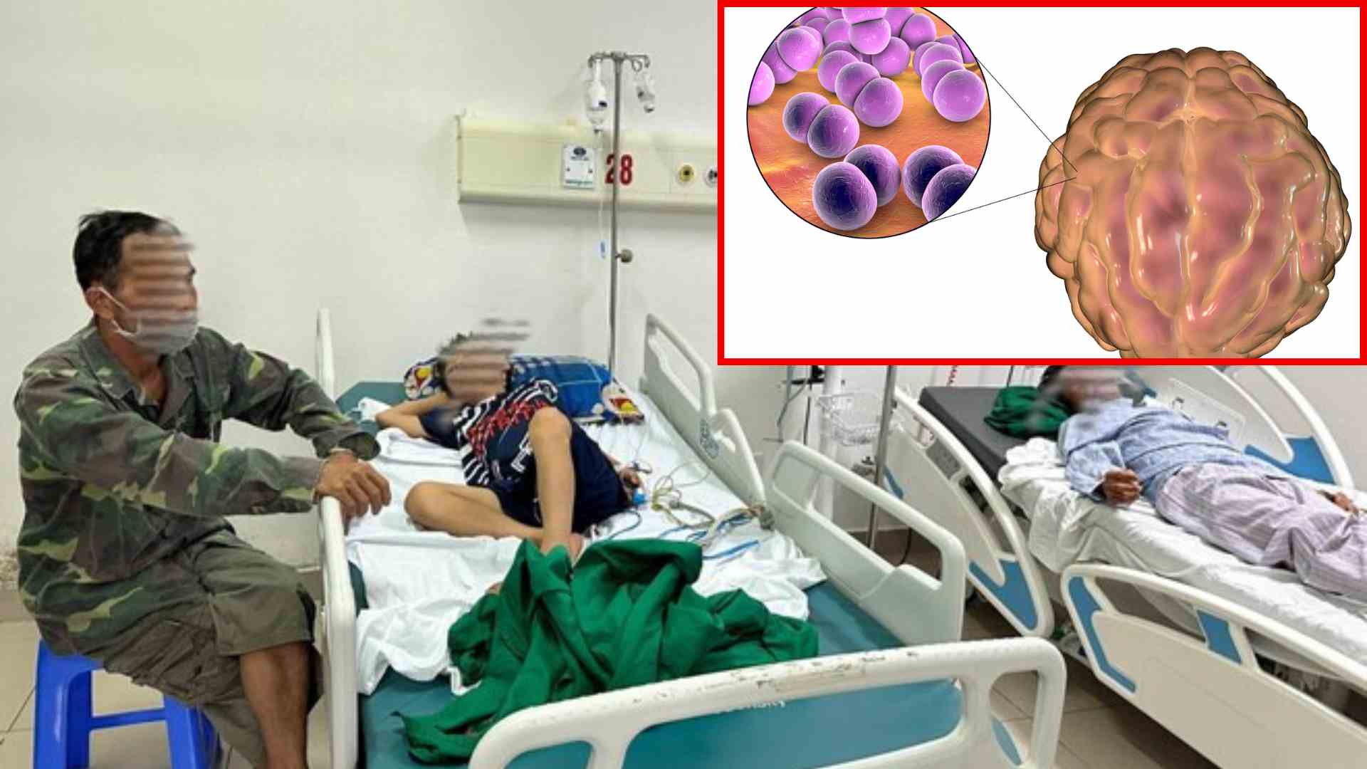 Bệnh não mô cầu | LAODONG.VN