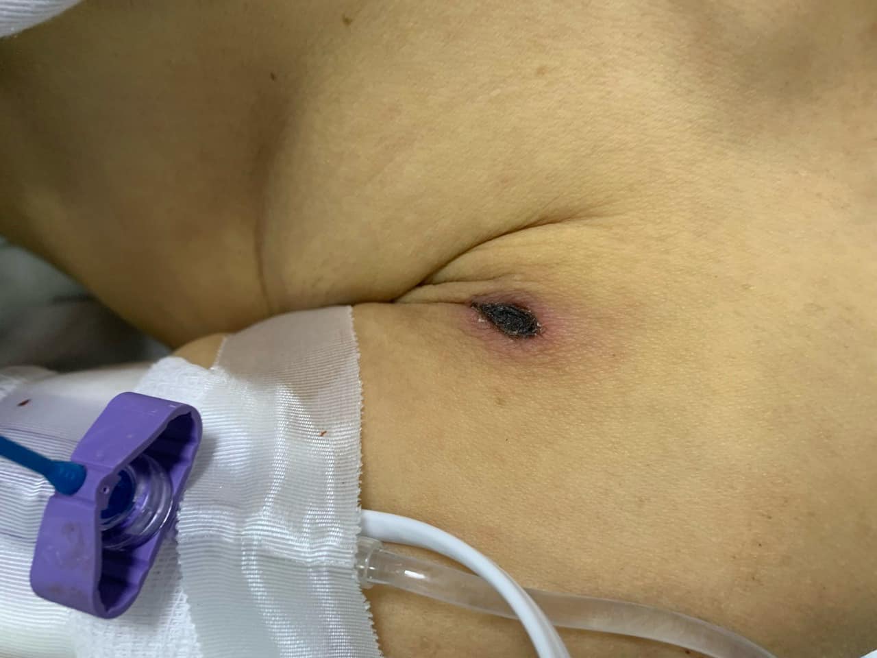 Vết loét khiến người bệnh nguy kịch. Ảnh: BVCC